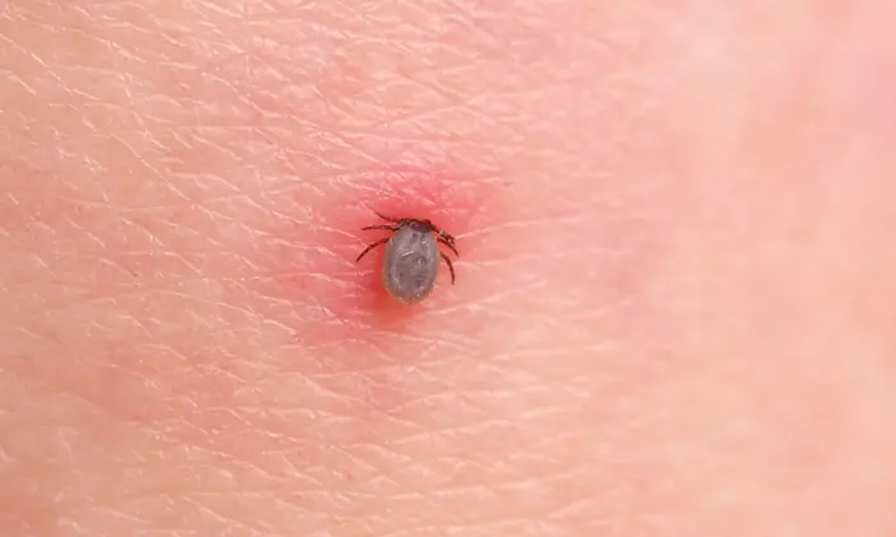 Lyme Disease