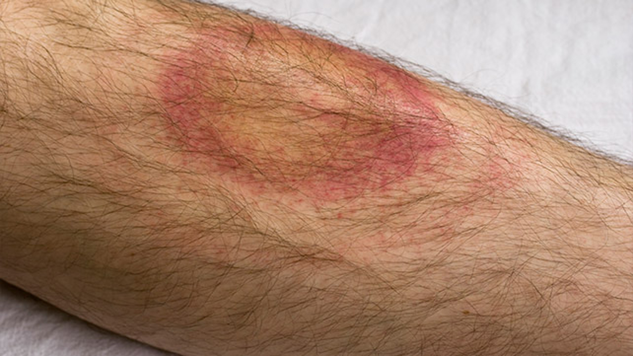 Ehrlichiosis